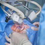 Lasik-Eye-Surgery-Alternatives