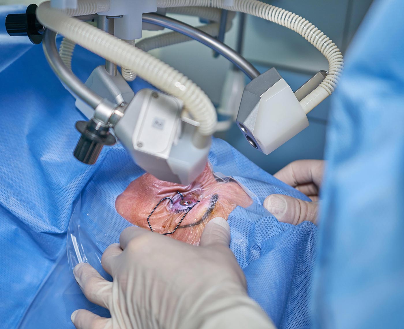 Lasik-Eye-Surgery-Alternatives